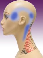 Smith Sinus Migraine Institute Blog - Doctor Migraine | Migraine Doctor